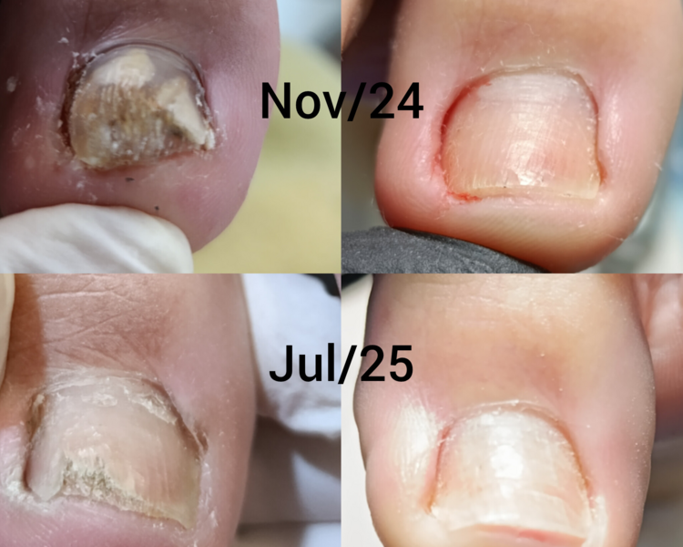 Sección para tratamiento de onicomicosis 