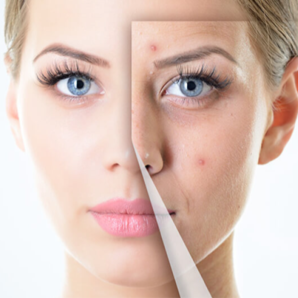 TRATATIENTO DE ACNE 5  SESIONES