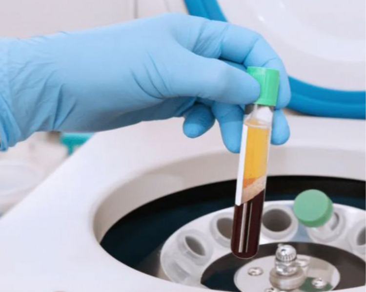 Plasma Rico en Plaquetas c/ Dermapen