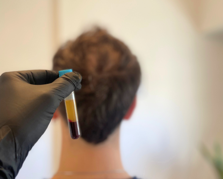 Plasma Rico en Plaquetas: Capilar 