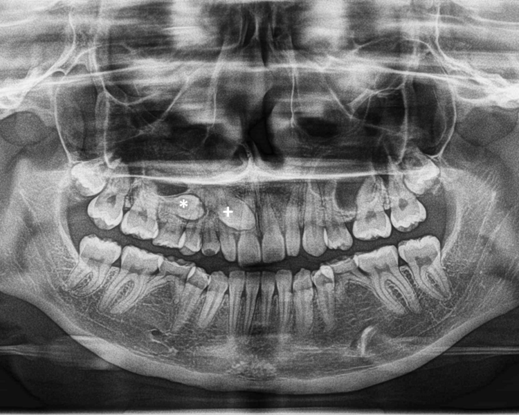 RX 1  ORTOPANTOMOGRAFIA (PANORAMICA)