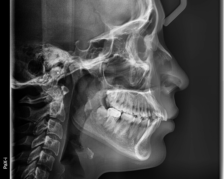 RX 2 RADIOGRAFIA LATERAL DE CRANEO (CEFALOMETRICA)