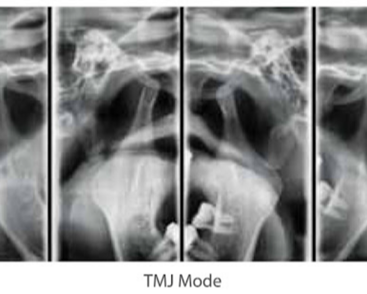 RX 3   RADIOGRAFIA   ATM  LATERAL ABIERTA Y CERRADA