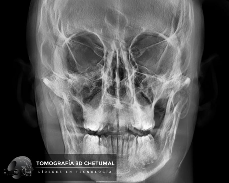 RX 4 RADIOGRAFIA POSTERO/ANTERIOR 