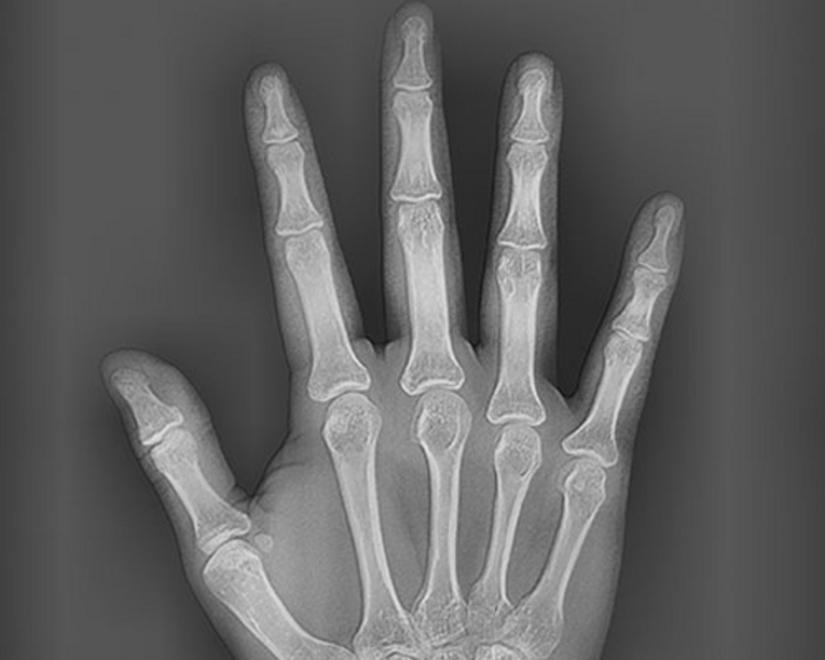 RX 5  RADIOGRAFIA CARPAL (MANO)