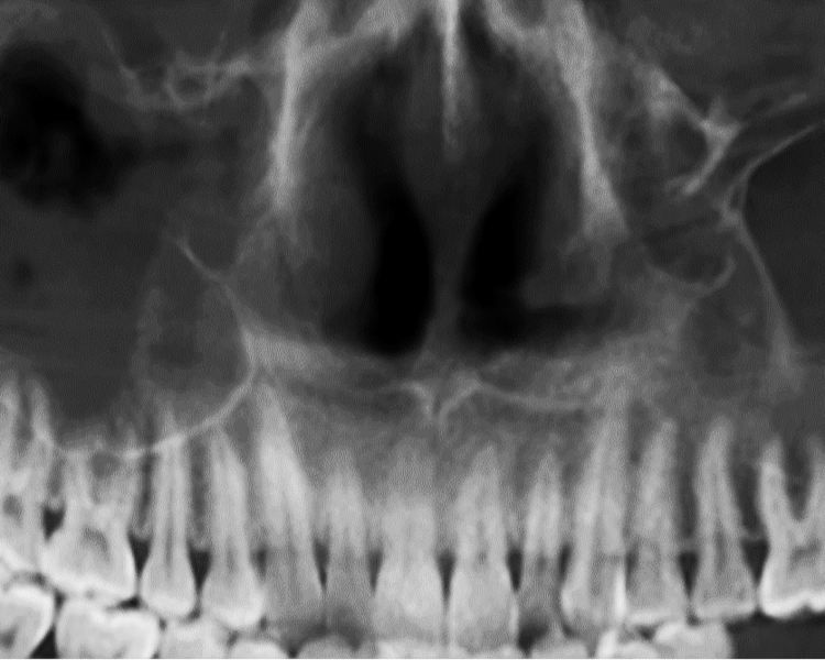 RX 6  RADIOGRAFIA  PANORAMICA DE SENOS MAXILARES 