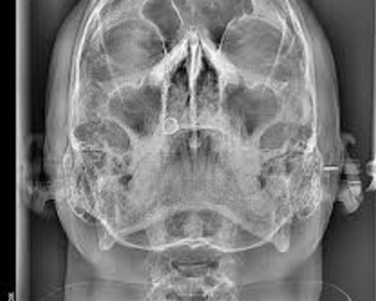 RX 7  RADIOGRAFIA WATERS