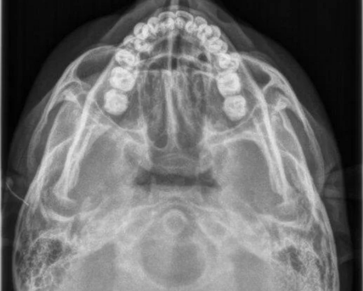 RX  9.1  RADIOGRAFIA SMV SUBMENTOVERTICAL