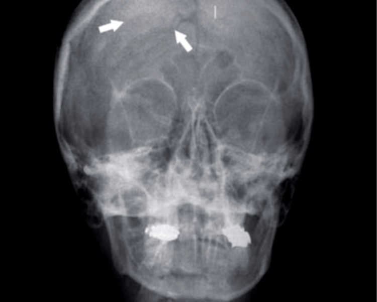 RX 9 RADIOGRAFIA TOWNES 