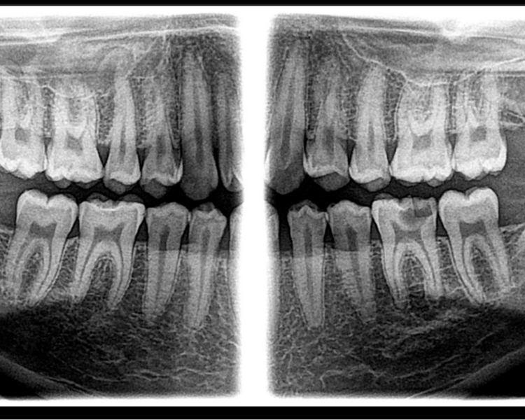 RX 9.3  RADIOGRAFIA INCISIVOS MOLARES
