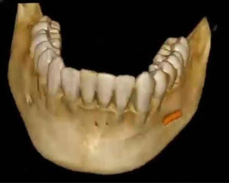 TOMOGRAFIA MAXILAR INFERIOR ( FOV 8X5 , 8X9 )