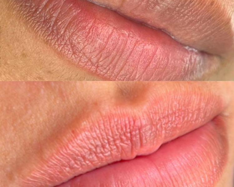 Neutralización de labios (oscuros y manchados)