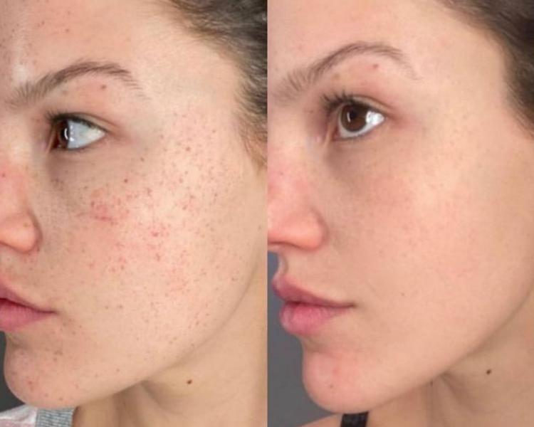 limpieza facial profunda con extracciónes