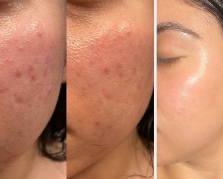 limpieza facial profunda con extracciónes