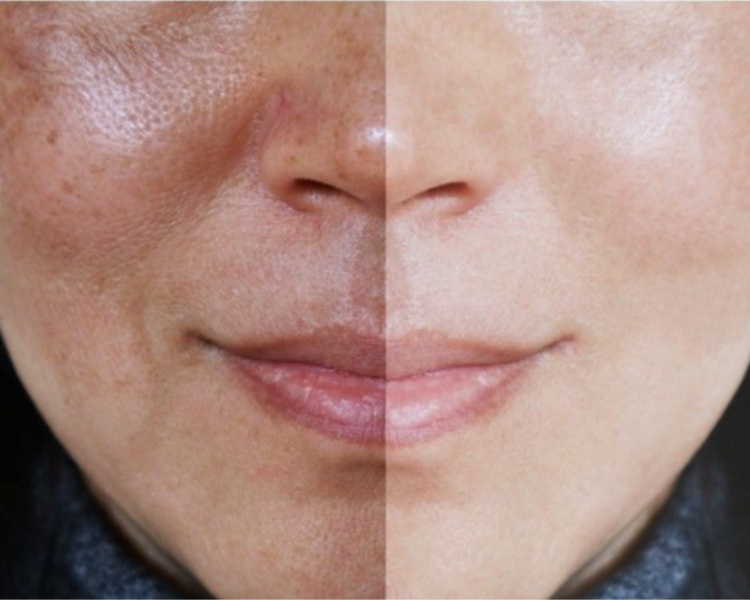 limpieza facial profunda +peeling personalizado para cada tipo de piel