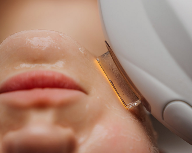 Tratamiento Facial Especializado IPL + Radiofrecuencia