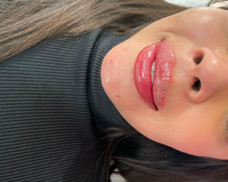 Rinolips 👃💋 