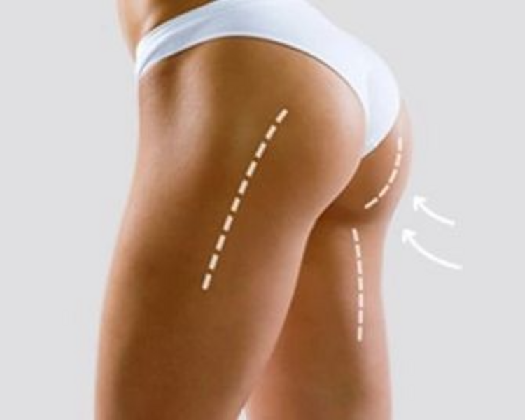 glúteos up - 4 sesiones