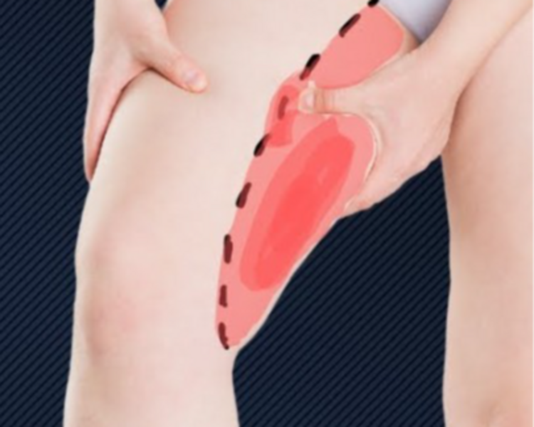 Láser en entrepierna 6 sesiones