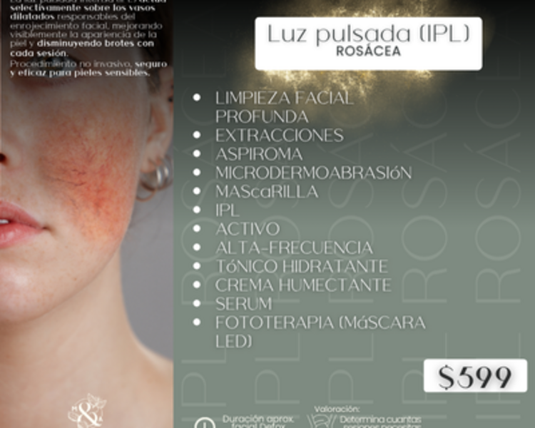 ROSÁCEA Luz pulsada (IPL)