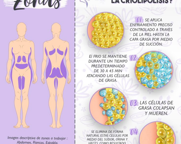criolipolisis- 4sesiones  