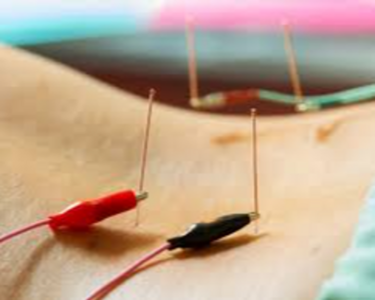 Electroacupuntura