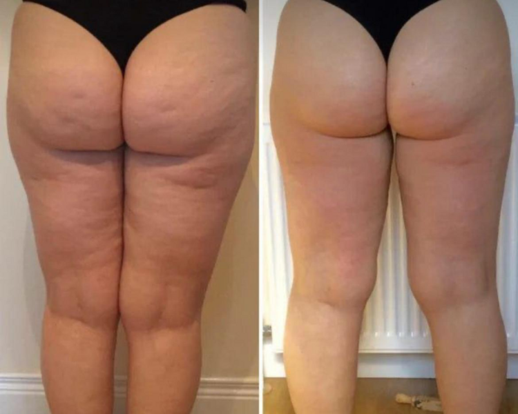 MASAJE LEVANTAMIENTO GLUTEO