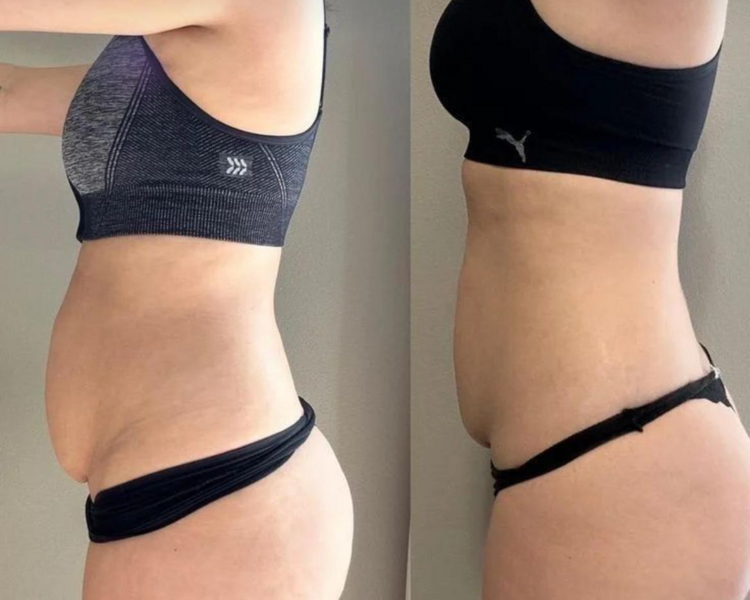 MASAJE REDUCTIVO ABDOMEN