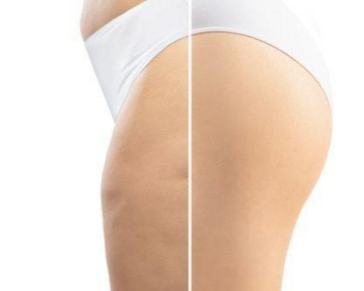 TRATAMIENTO ANTICELULITICO