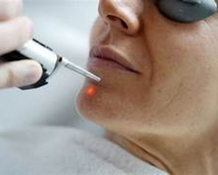 Láser despigmentante