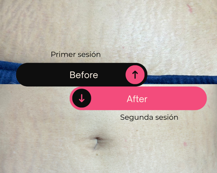 Zona mediana 3 sesiones