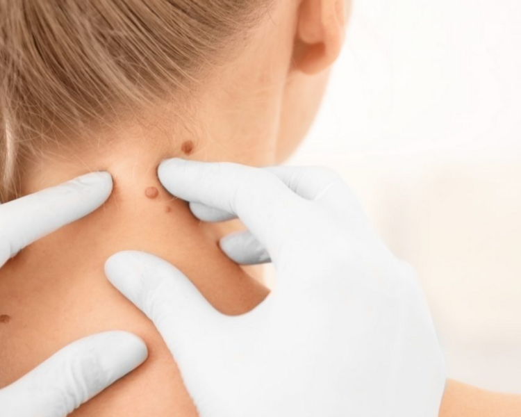 Retiro 11-20 verrugas