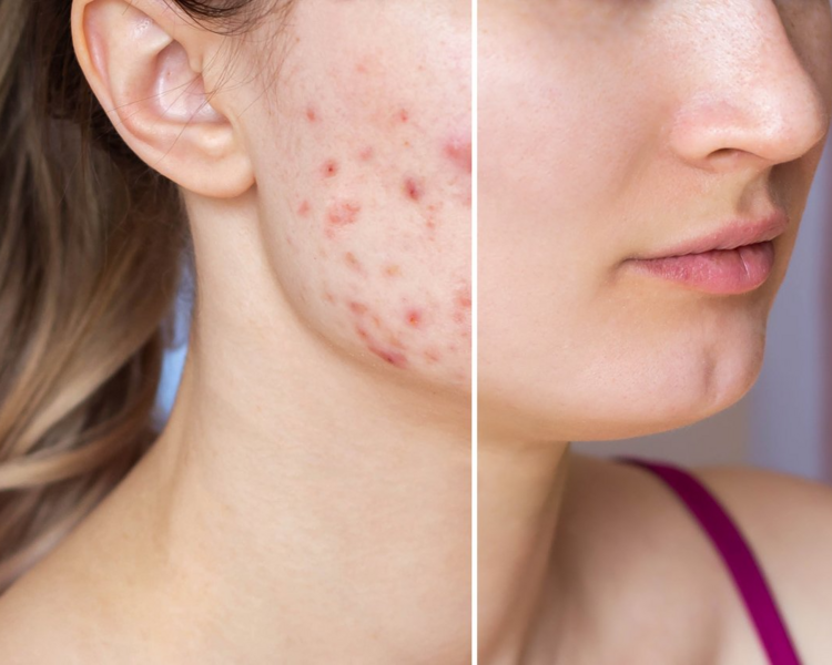 Tratamiento para acné 