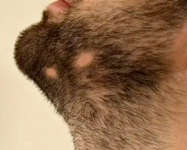 Minoxidil (Barba)