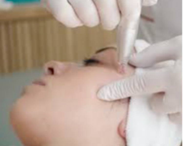 MICRONEEDLING FACIAL (Dermapen)