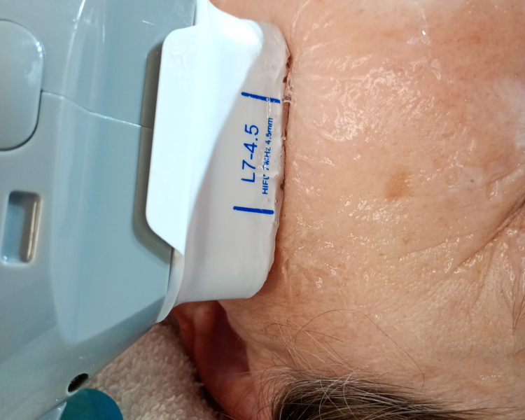 Hifu facial zona pequeña 
