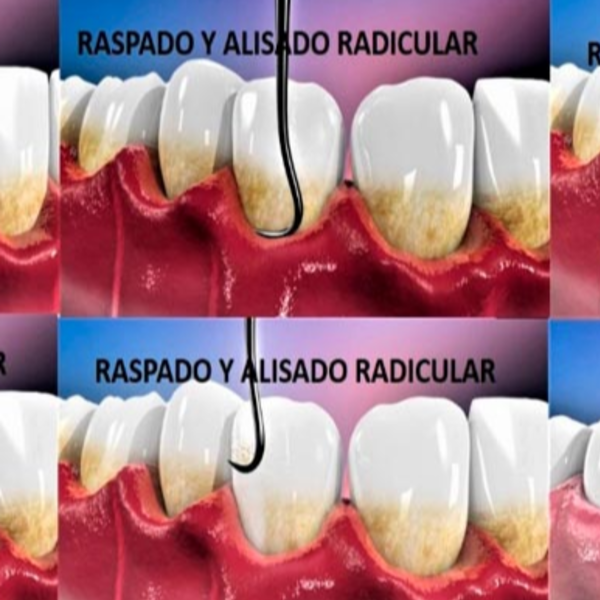 Raspaje y Alisado  Radicular  