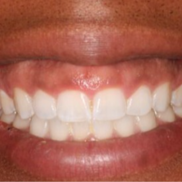 Gingivectomia / Gingivoplastia