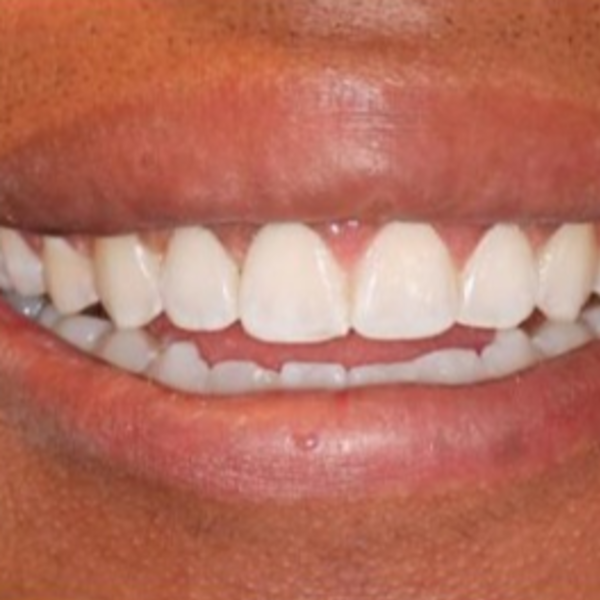 Gingivectomia / Gingivoplastia