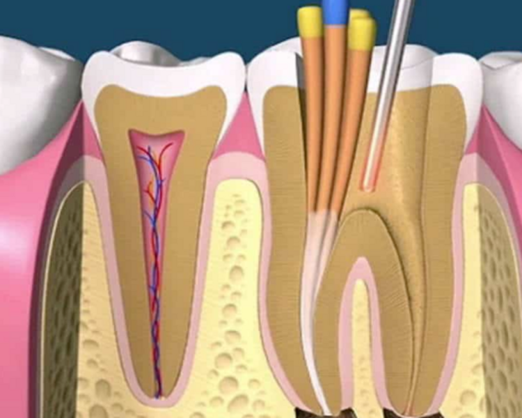 Tratamiento De Conducto 
