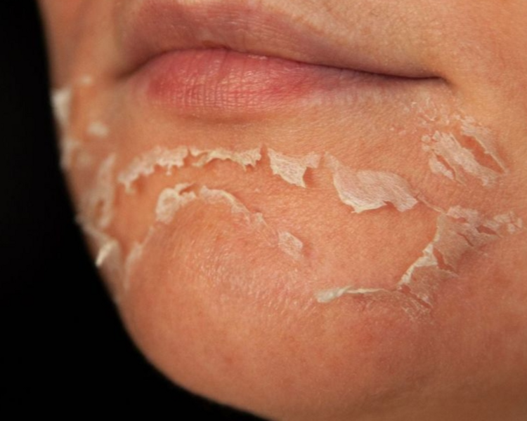 Peeling Químico 🧪