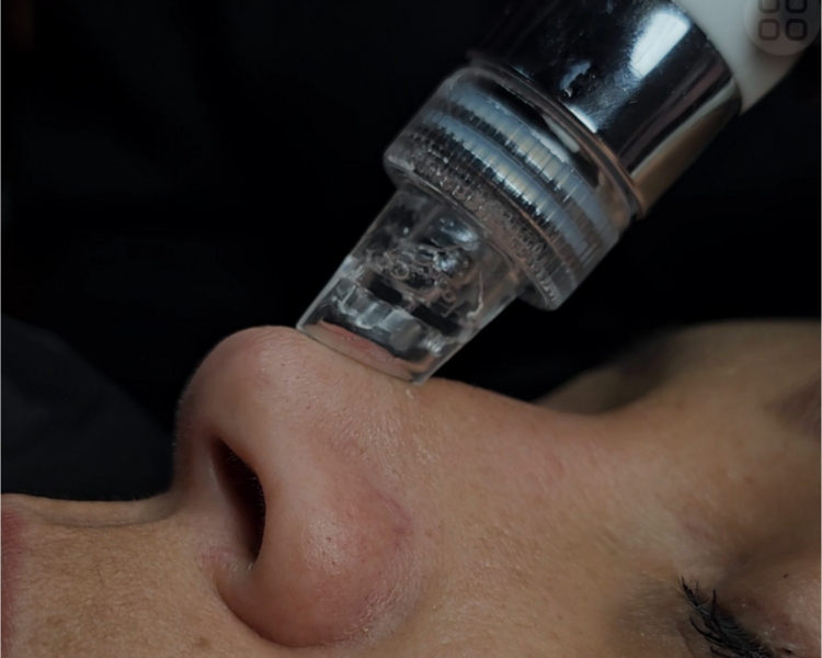 Limpieza Facial Pro (Hydrafacial)