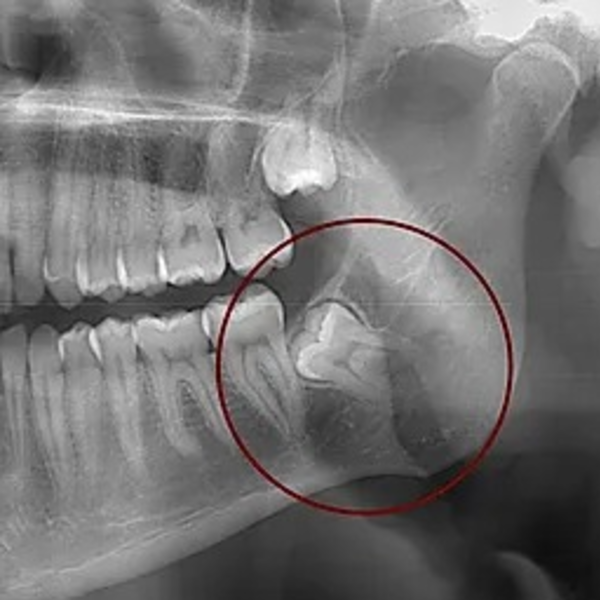 Exodoncia de Terceros Molares 