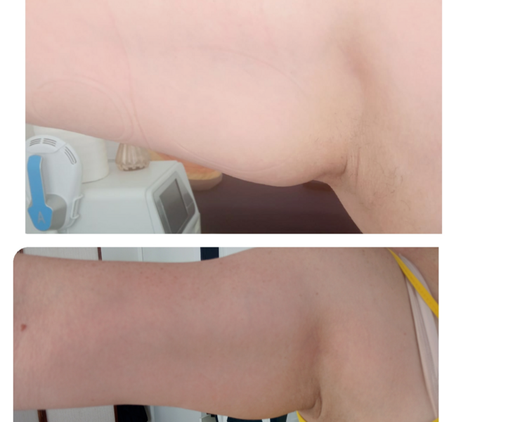 Tratamiento Reafirmante en brazos 