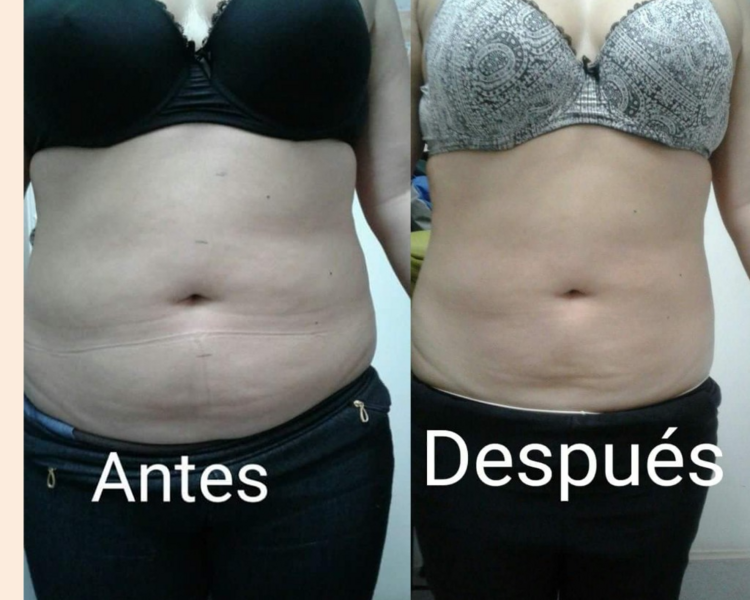 Tratamiento Reductivo 8 sesiones ( abdomen o brazos o piernas)tu escoges zona a tratar 