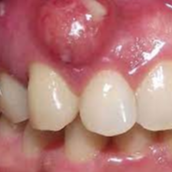 Absceso  Periodontal 