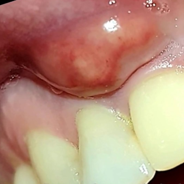 Absceso  Periodontal 