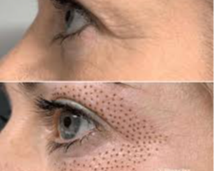 Estiramiento de Párpados