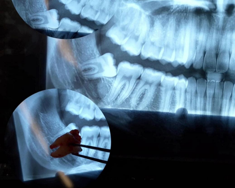 CIRUGIA DE DIENTE RETENIDO O IMPACTADO