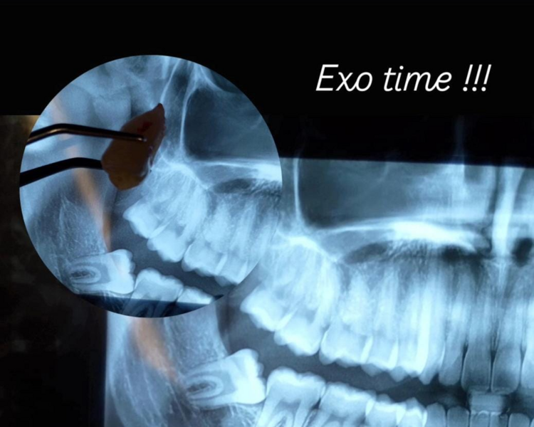 EXTRACCIONES 3ER MOLAR